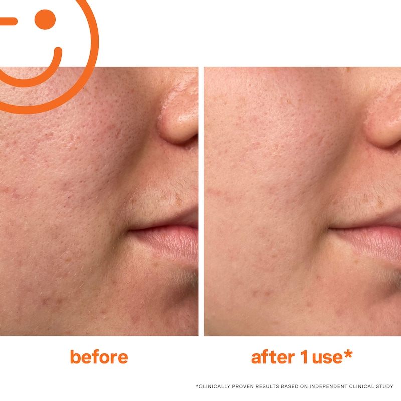 ExfoliKate Intensive Exfoliating Treatment AHA + BHA Resurfacing Facial thumbnail 2