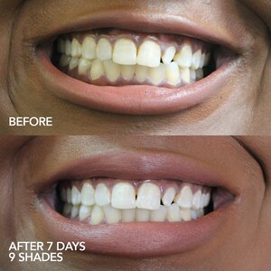 Glo Lit At Home Teeth Whitening Device Kit Glo Science Sephora