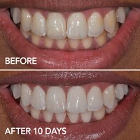 GLO Brilliant Teeth Whitening GLO Vials 10 Pack plus Lip Care