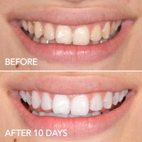 GLO Brilliant Teeth Whitening GLO Vials 10 Pack plus Lip Care