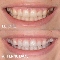 GLO Brilliant Teeth Whitening GLO Vials 10 Pack plus Lip Care