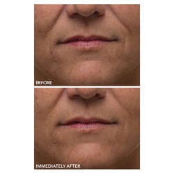 dennis gross gentle peel