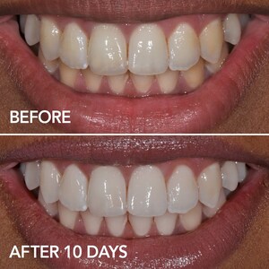 Glo Lit Teeth Whitening Vials 7 Pack Lip Care Glo Science Sephora