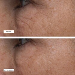 perricone md eye cream for dark circles