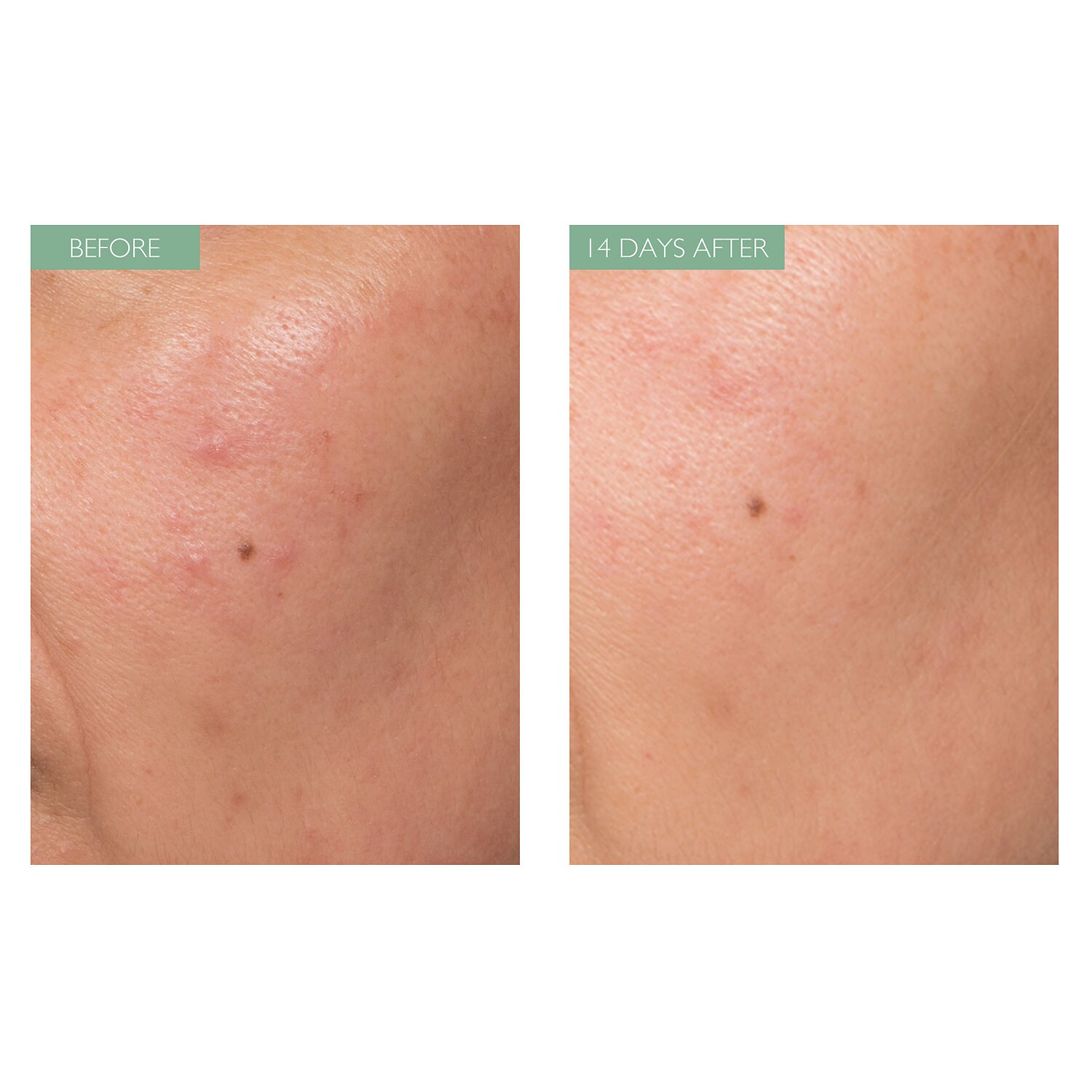 caudalie acne scars