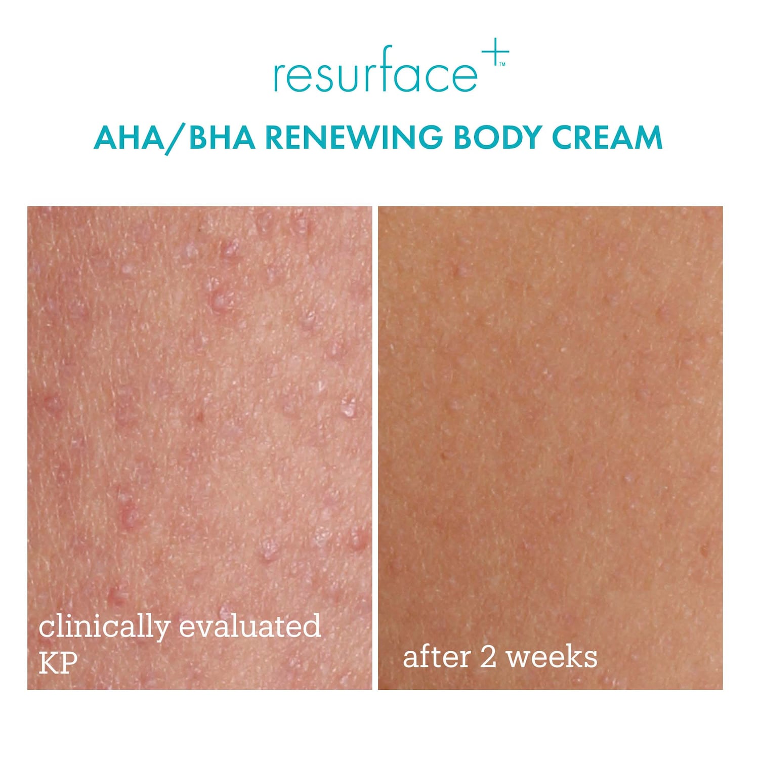 Skinfix Resurface+ Aha Renewing Body Cream Big Apple Buddy