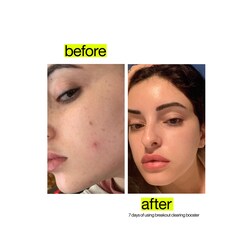 dermalogica target breakouts