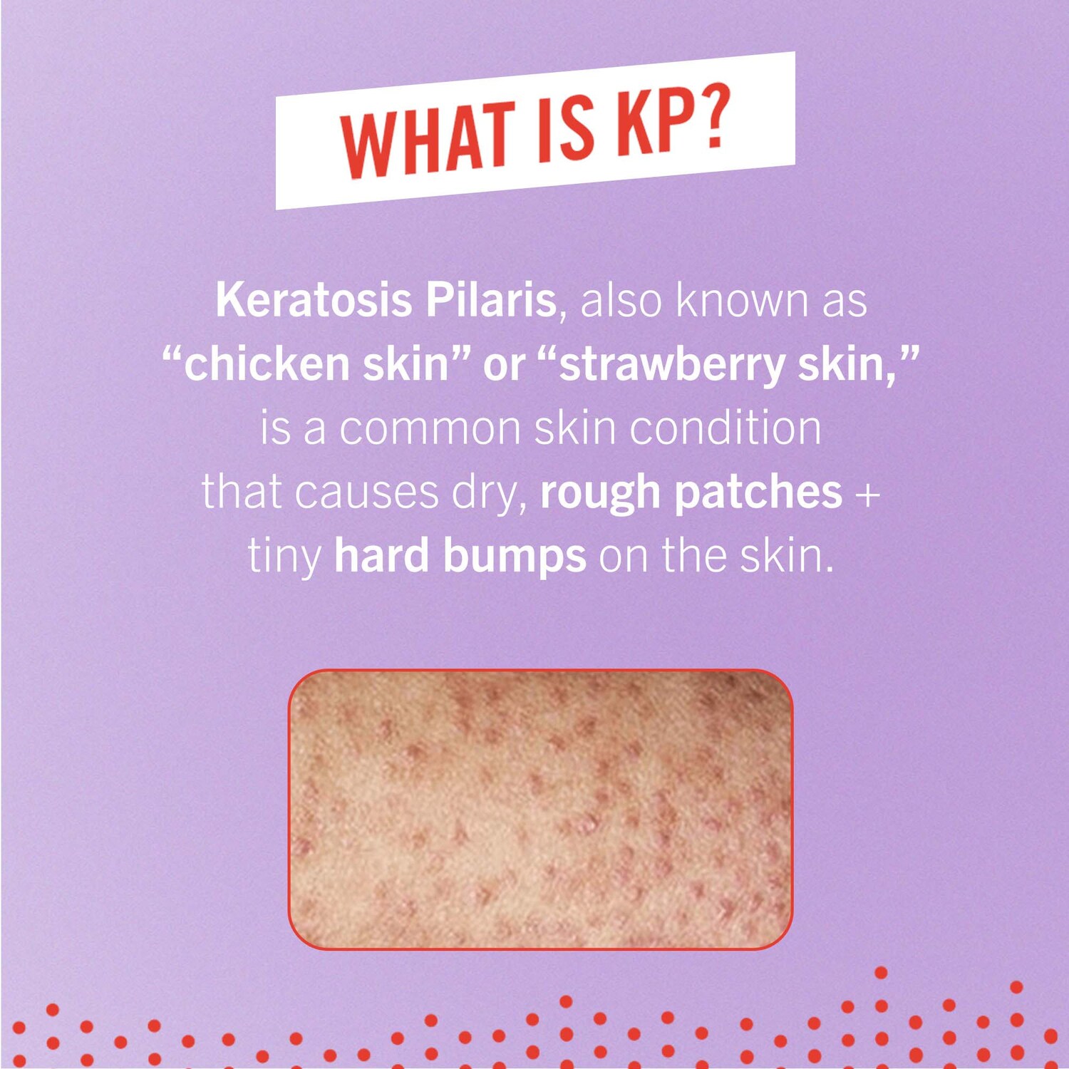 Kp Bump Eraser Body Scrub With 10 Aha First Aid Beauty Sephora Kp Bump Eraser Body Scrub With 10 Aha First Aid Beauty Sephora