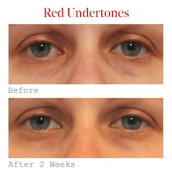 l-carnitine vs vitamin c for under eye bags Revitalizer Lactic acid is combined with three forms of vitamin C to increase absoption and enhance antioxidant performance for eye L-carnitine: what essential information should