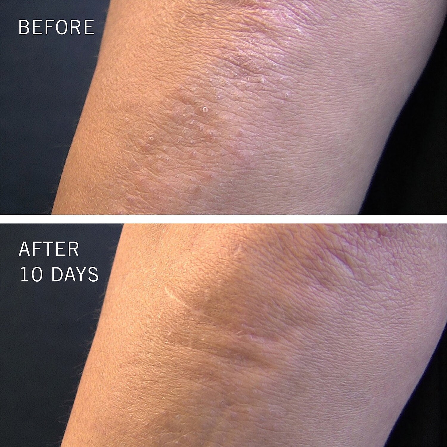 First Aid Beauty Kp Bump Eraser Body Scrub With 10 Aha Duo Big Apple Buddy