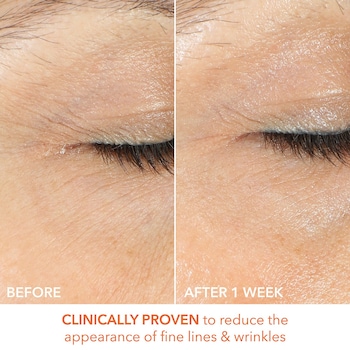 l-carnitine vs vitamin c for under eye skin Cream Dark Circles and Eye Bags  Joy Pretty Wrinkles 90% of subjects saw a reduction in the look of crow_x0092_s feet Vitamin C Under Eye 