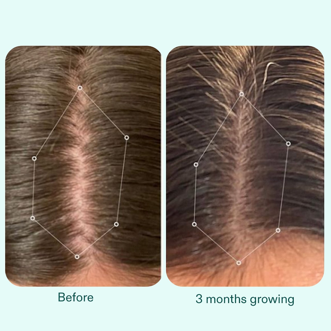 Nutrafol POSTPARTUM OBGYNFormulated Hair Growth Supplement for Thinning & FullBody Recovery