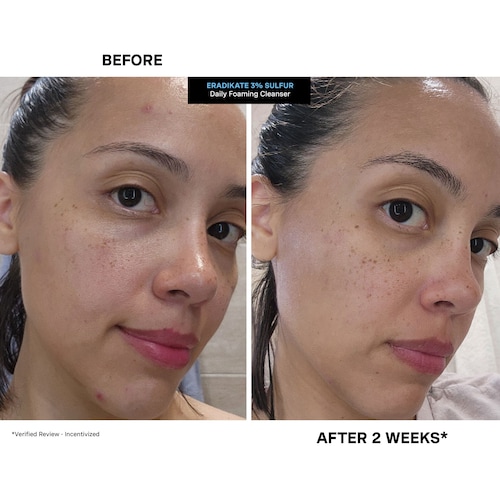 EradiKate™ Daily Cleanser with Sulfur Acne Treatment