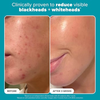 Skin Perfecting 2% BHA Liquid Exfoliant