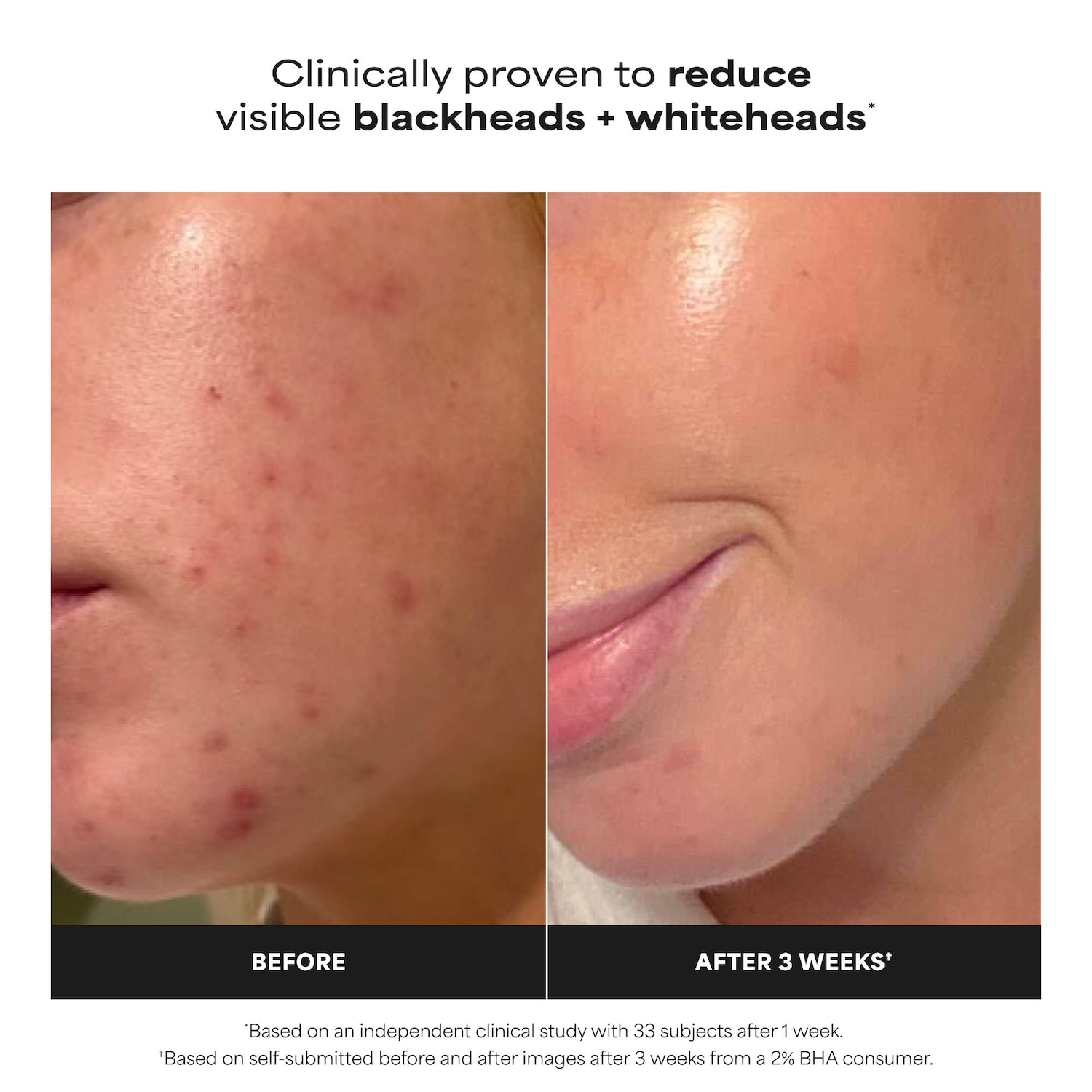 Skin Perfecting 2% BHA Exfoliating Toner for Clear