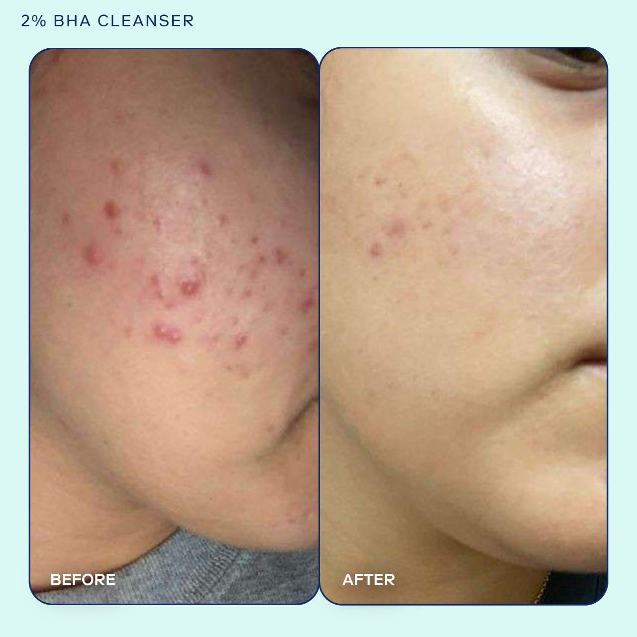 Очищающее средство Skinfix Acne+ с 2% BHA, азелаиновой кислотой, ниацинамидом и AHA — фото 3