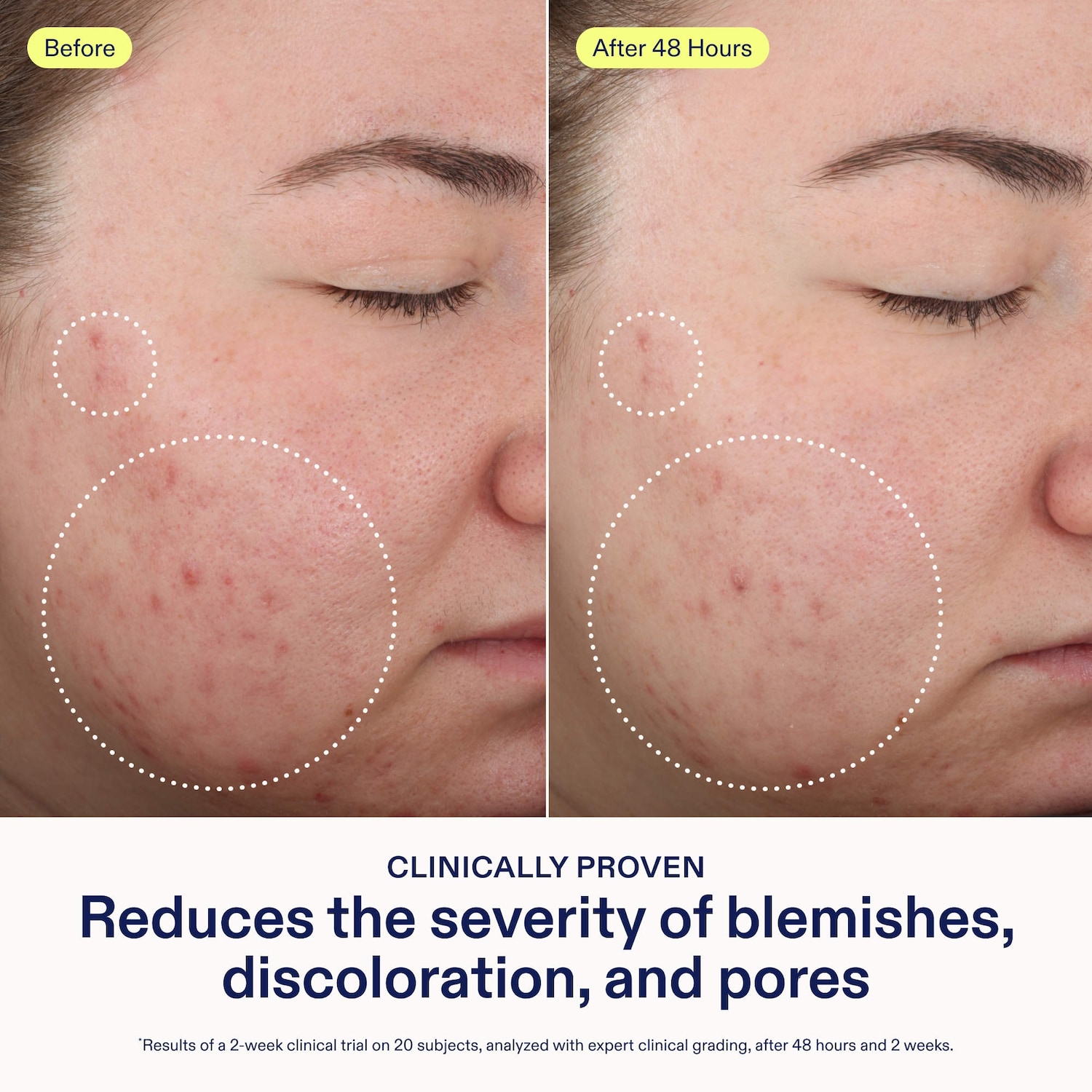 Acne+ 2% BHA + Azelaic Acid + Niacinamide + AHA Cleanser - Skinfix