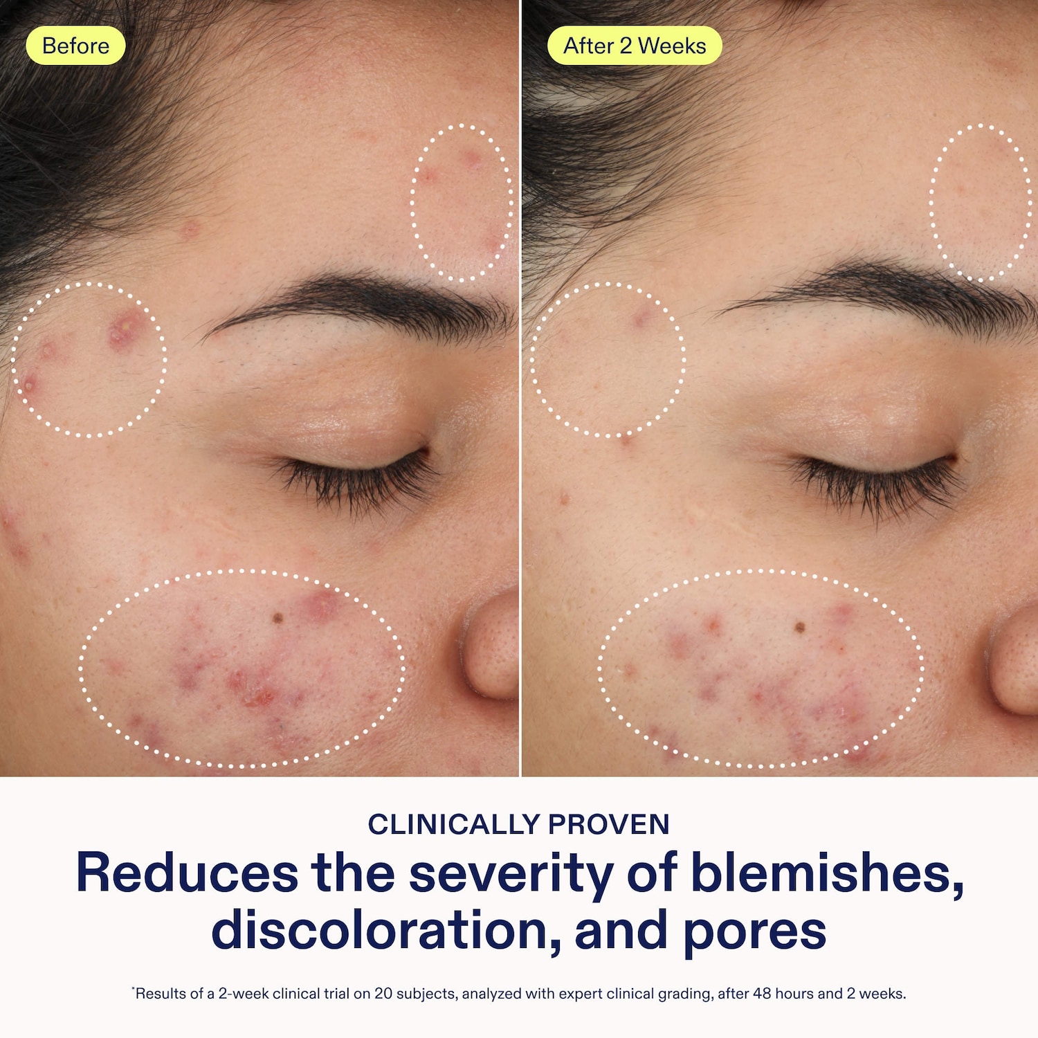 Acne+ 2% BHA + Azelaic Acid + Niacinamide + AHA Cleanser
