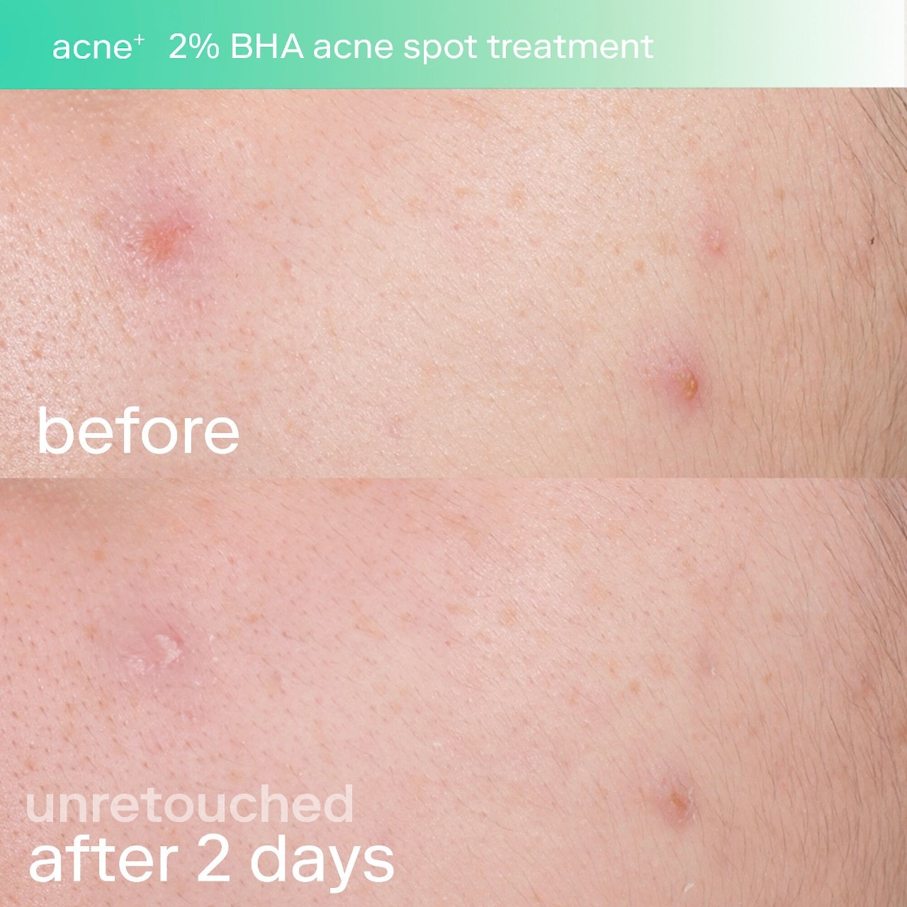 Точечное средство от акне Skinfix Acne+ с 2% BHA и азелаиновой кислотой — фото 2