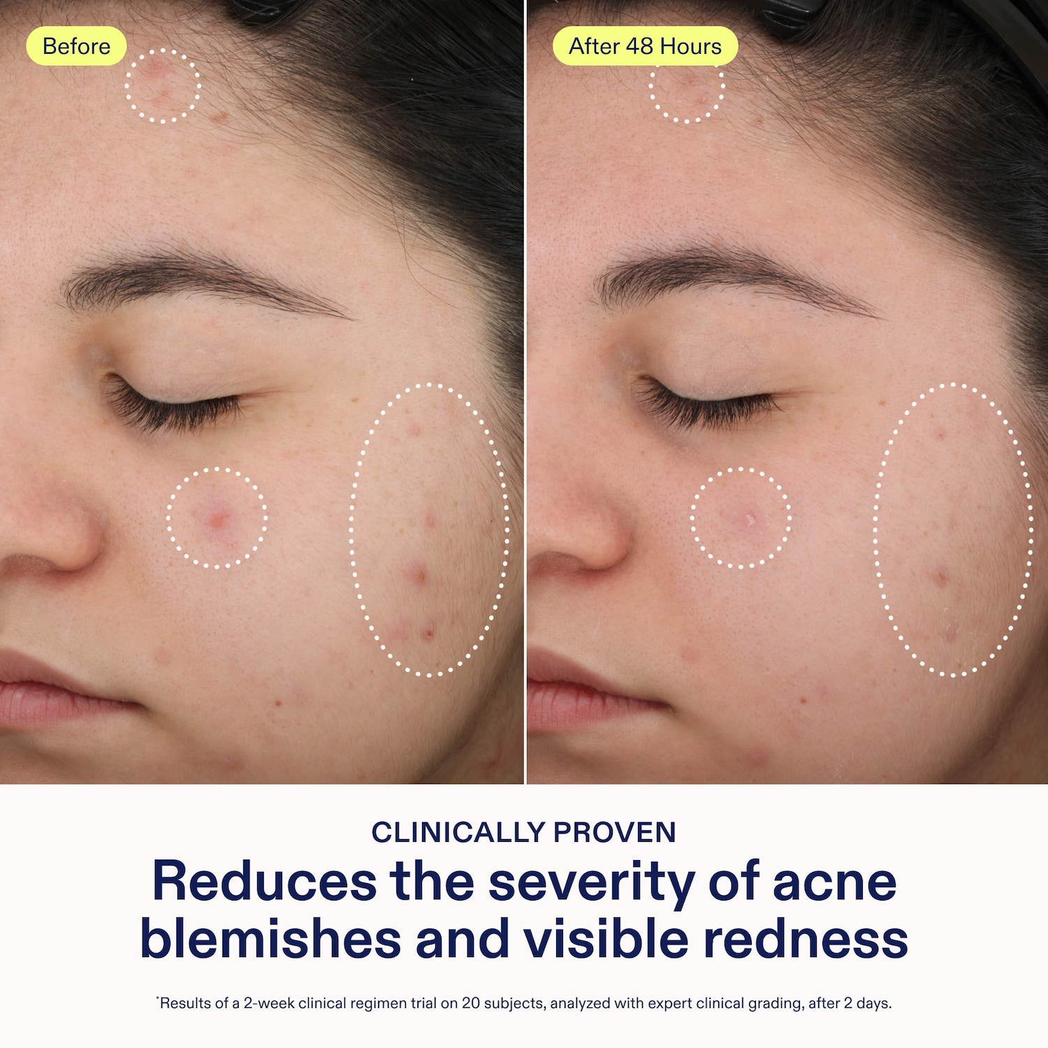 Acne+ 2% BHA and Azelaic Acid Acne Spot Treatment