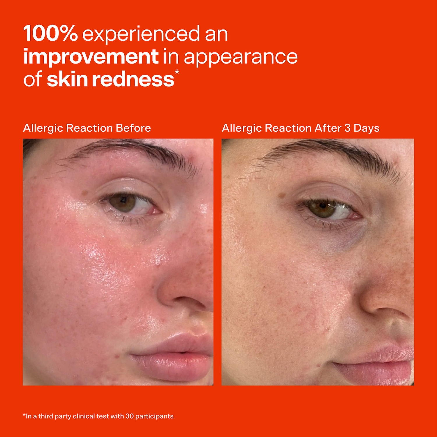 SOS Daily Hypochlorous Acid Spray for Breakouts & Redness