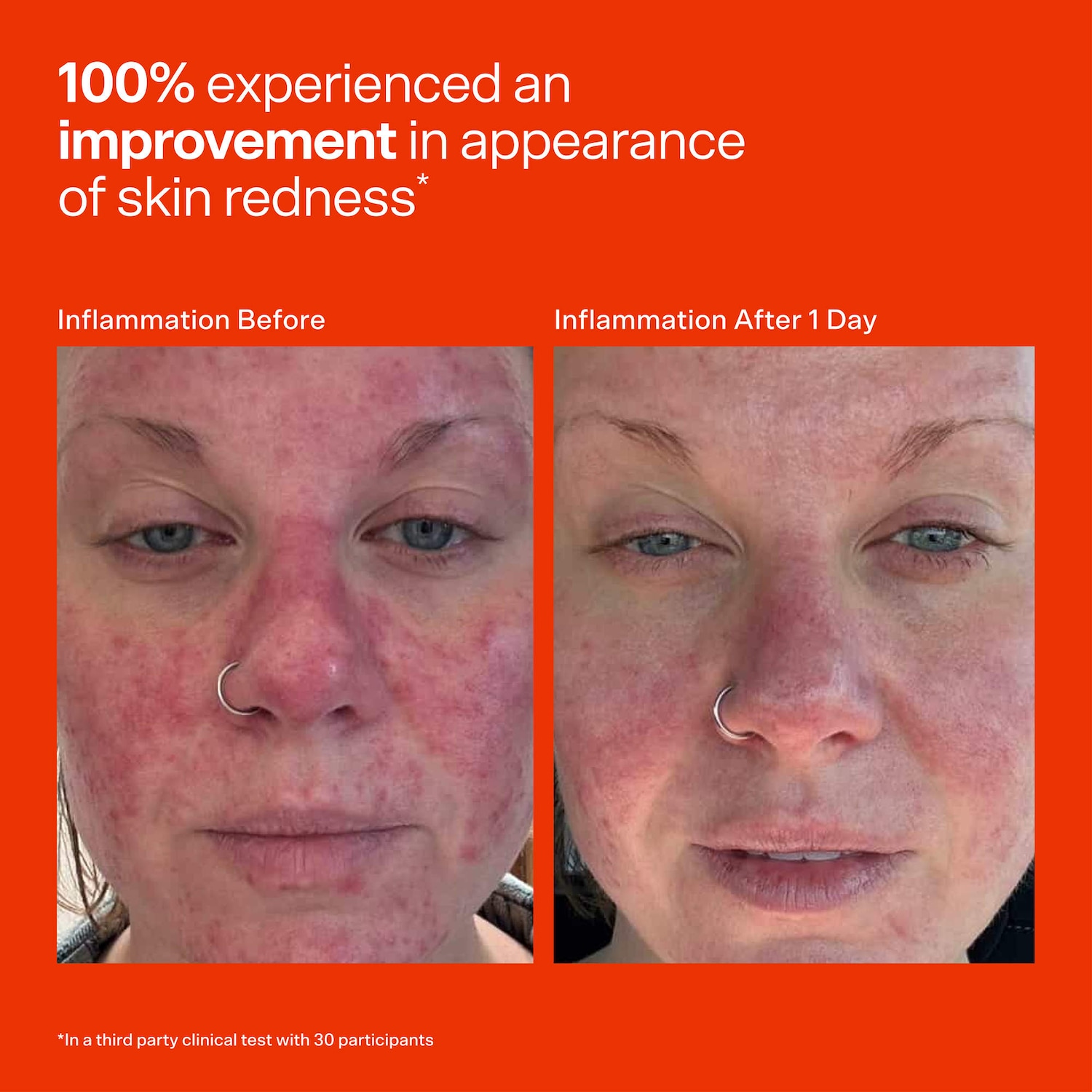 SOS Daily Hypochlorous Acid Spray for Breakouts & Redness