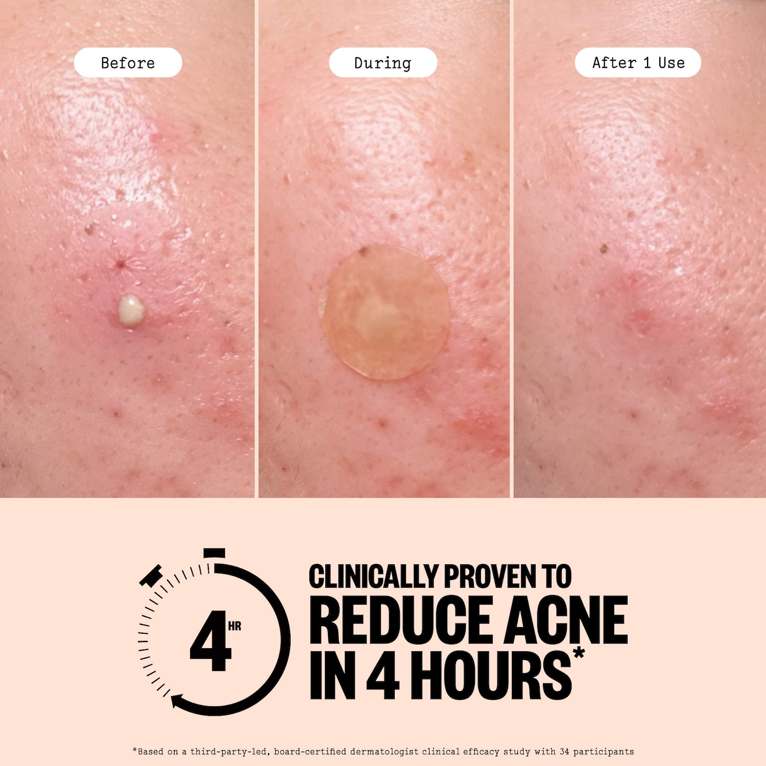 Salicylic Acid & Hydrocolloid Acne Treatment Pimple Patches