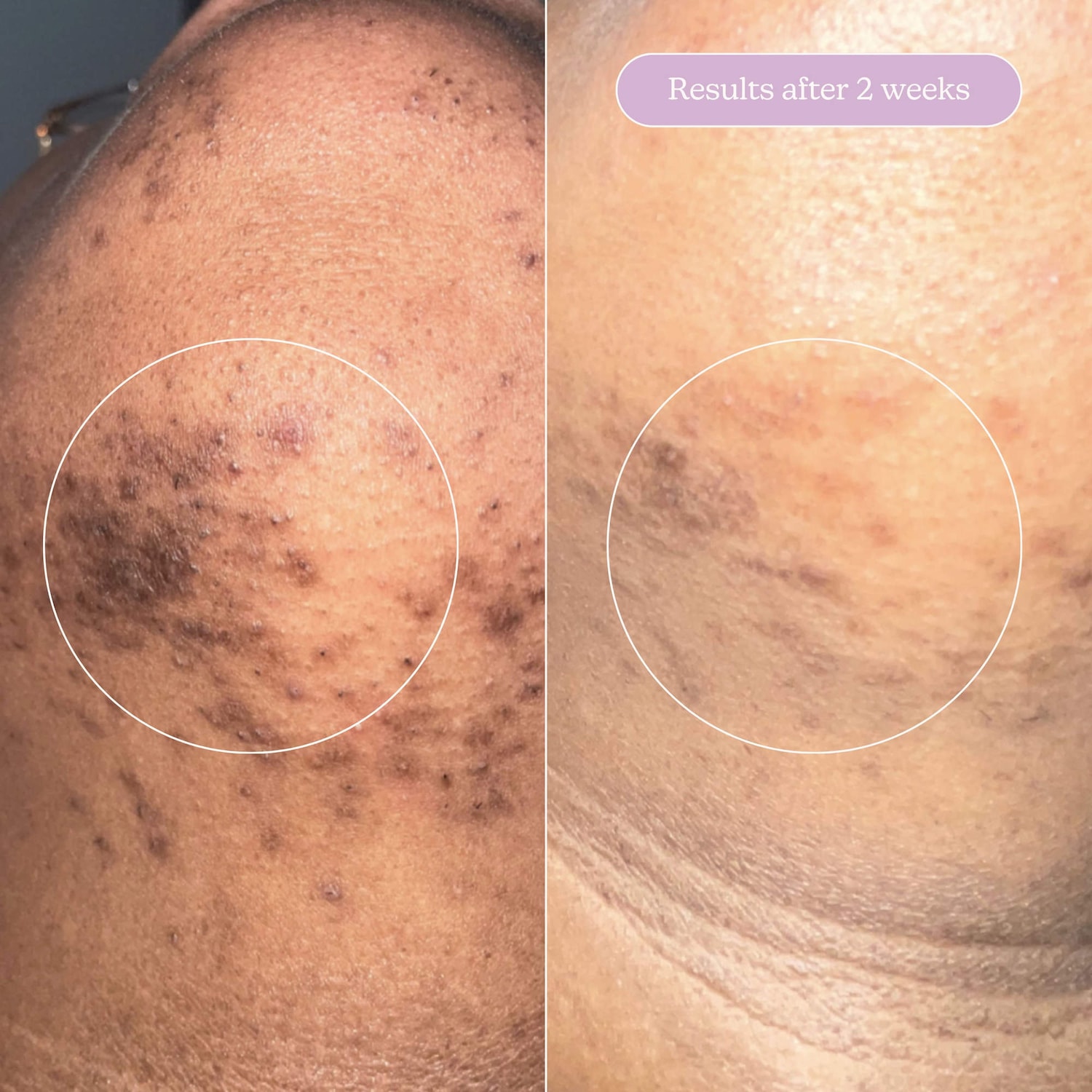 Sérum estompeur de cicatrice + taches pigmentaires Milky