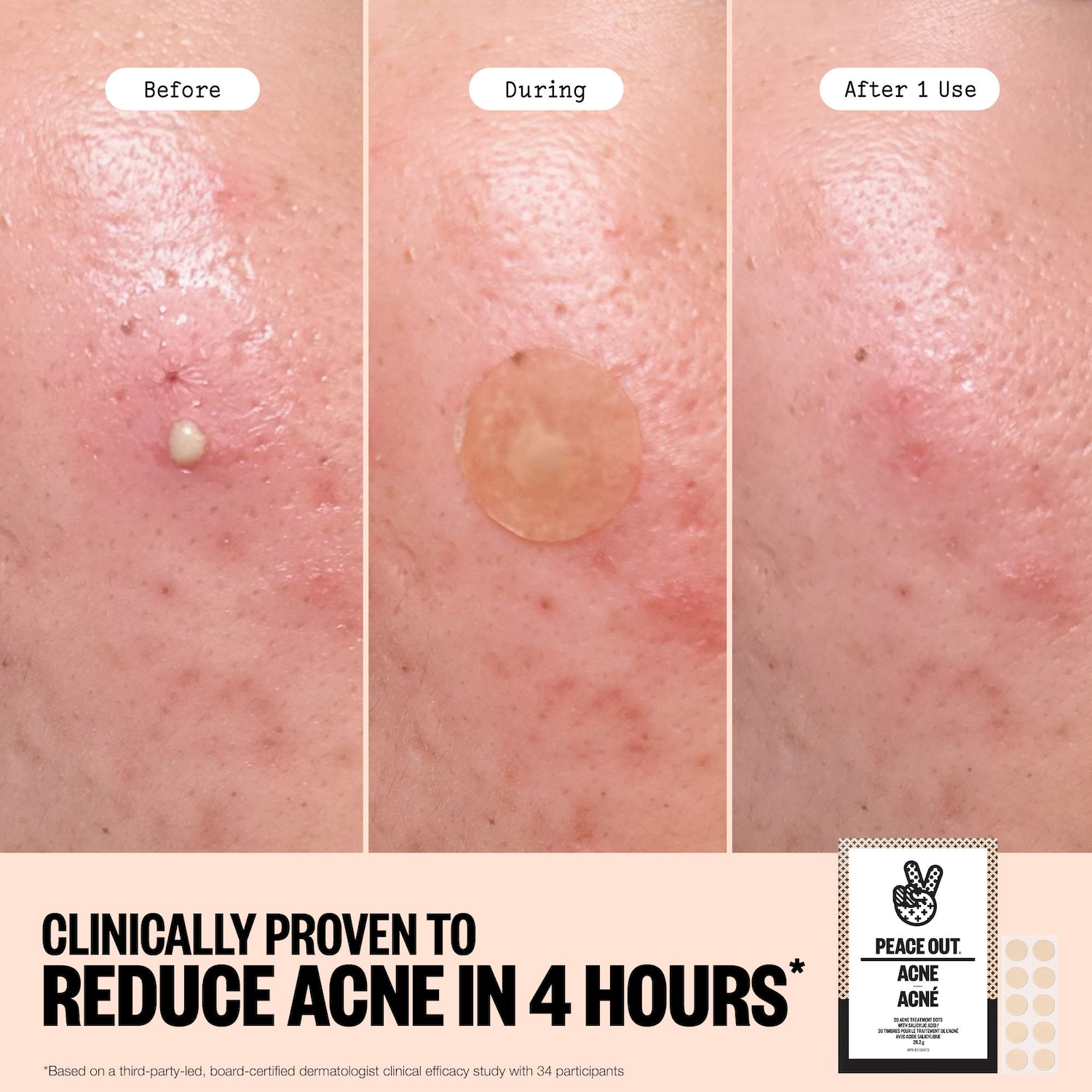 Peace Out Salicylic Acid Acne Healing Dots Mega Value Pack + Free Travel Bag