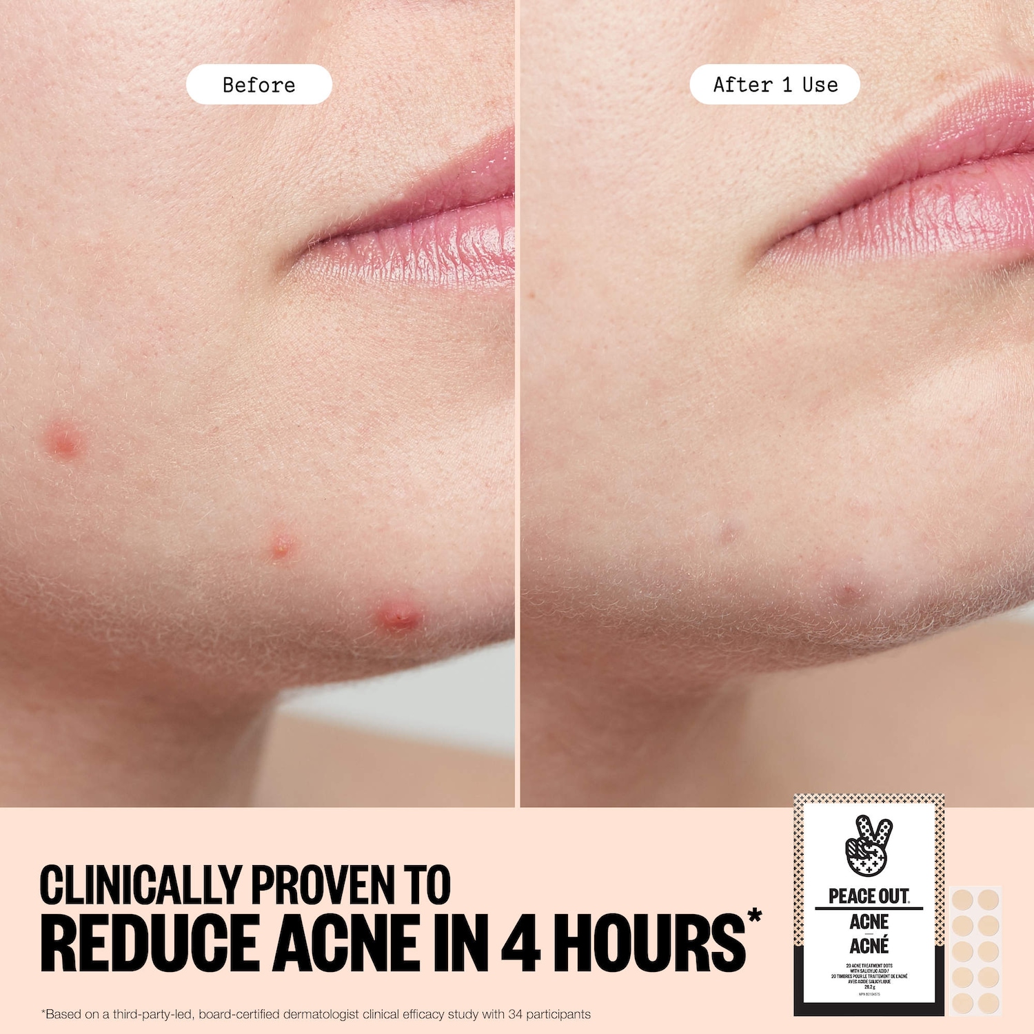 Peace Out Salicylic Acid Acne Healing Dots Mega Value Pack + Free Travel Bag