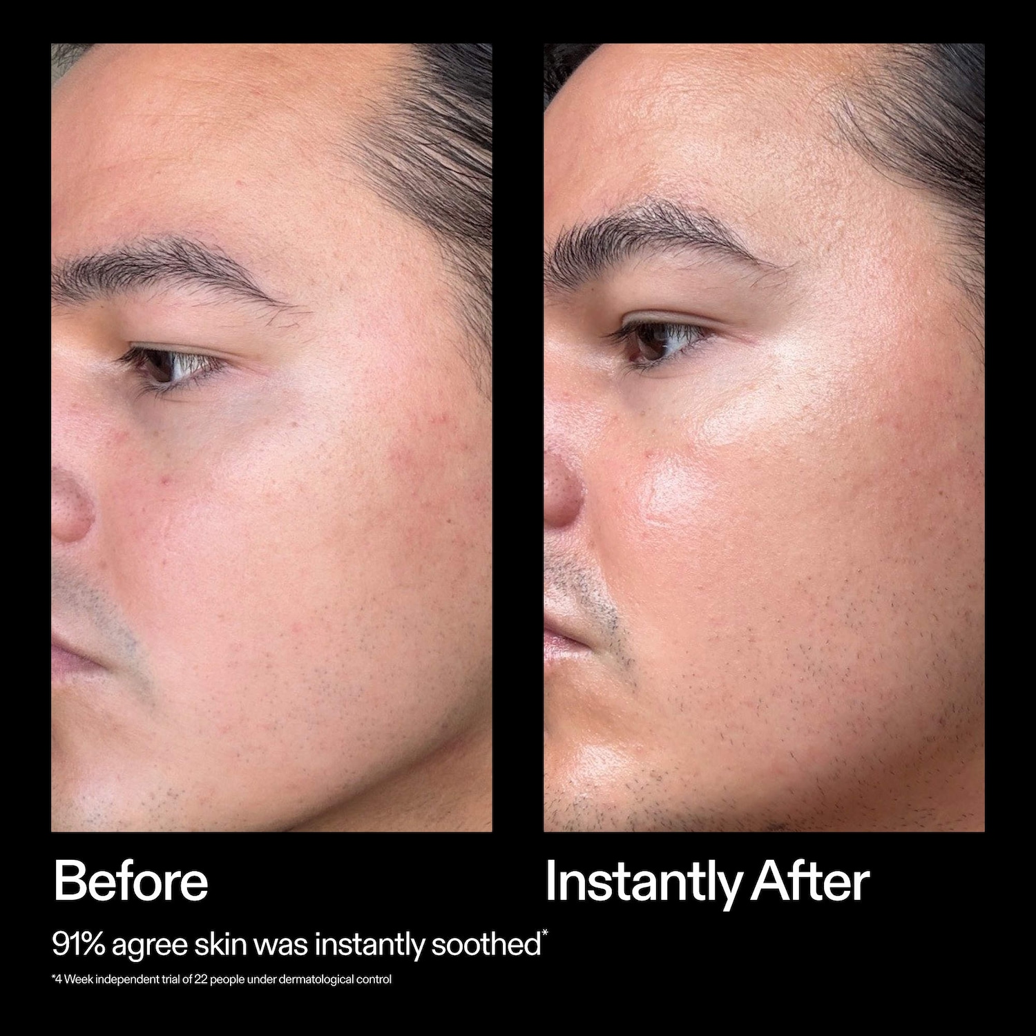 SuperSolutions 10% Azelaic Serum Redness Relief Solution - The