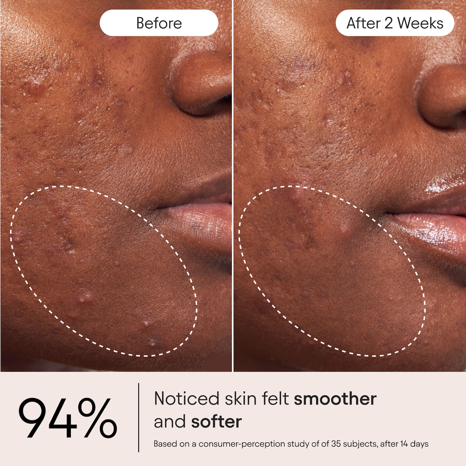 2% BHA Pore Perfecting Liquid Exfoliator for Brighter & Clearer Skin