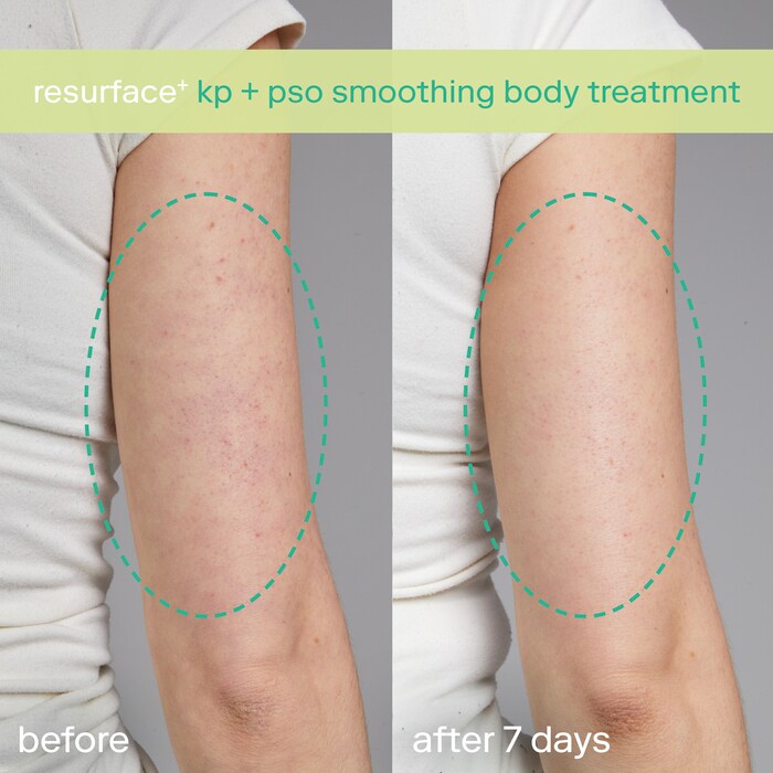 KP+ Psoriasis Smoothing Treatment Body Lotion thumbnail 4