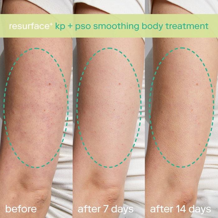 Лосьон для тела Skinfix KP+ для разглаживания кожи при псориазе — фото 4