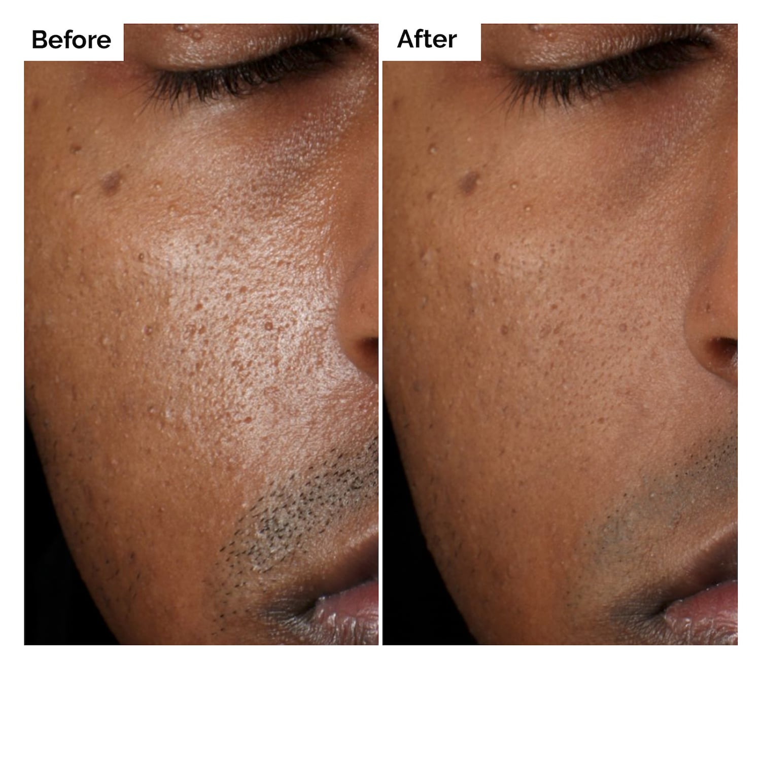Aloe 2% + NAG 2% Solution for Post-Acne Marks