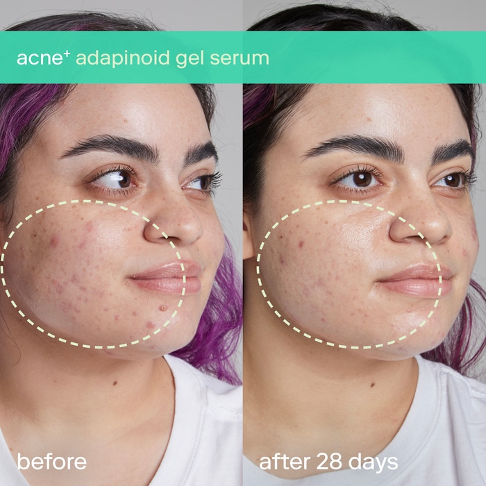 Гель с ниацинамидом и скваланом против акне Skinfix acne+ adapinoid — фото 2