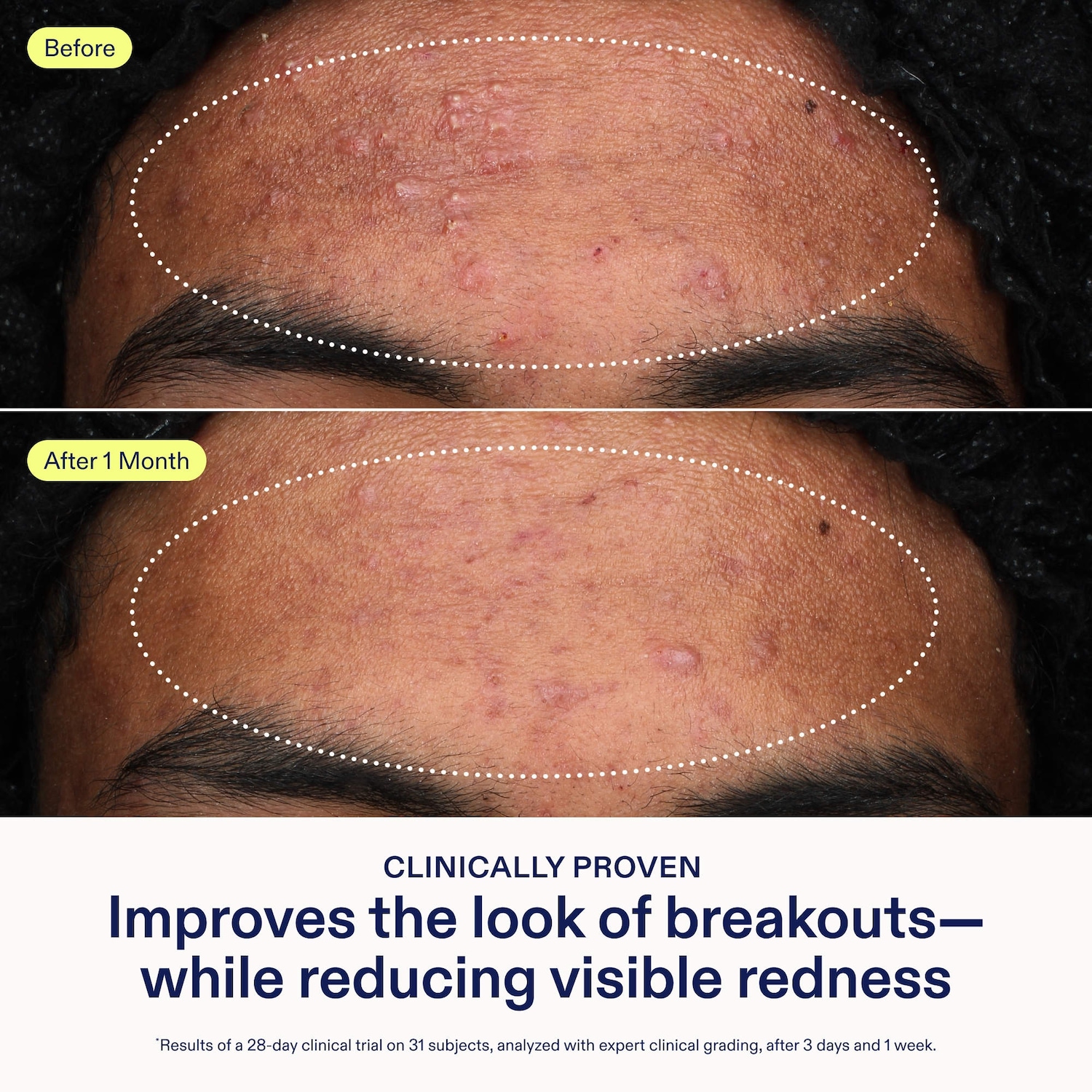 acne+ adapinoid Gel with Niacinamide + Squalane