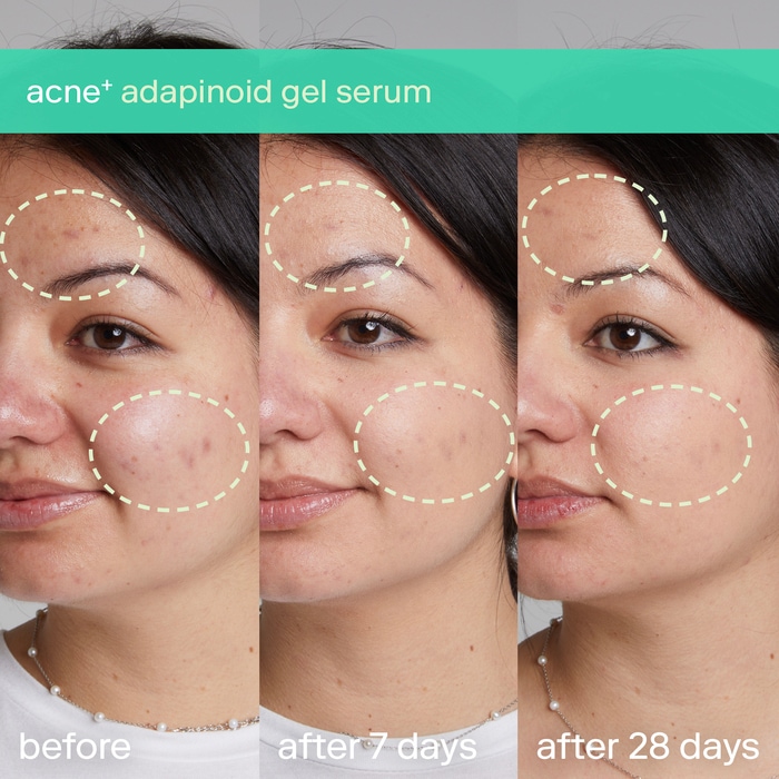 Гель с ниацинамидом и скваланом против акне Skinfix acne+ adapinoid — фото 3