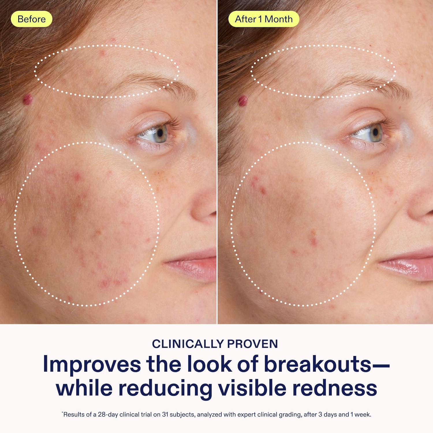 acne+ adapinoid Gel with Niacinamide + Squalane