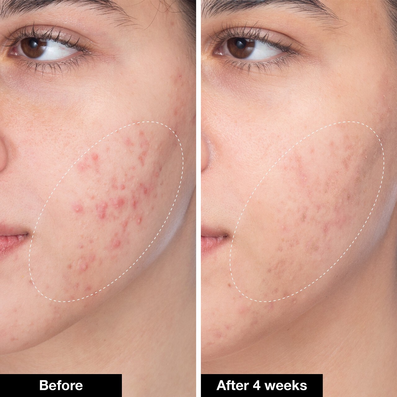 INNBEAUTY PROJECT Acne Serum Medicated Treatment for Acne & Blackheads