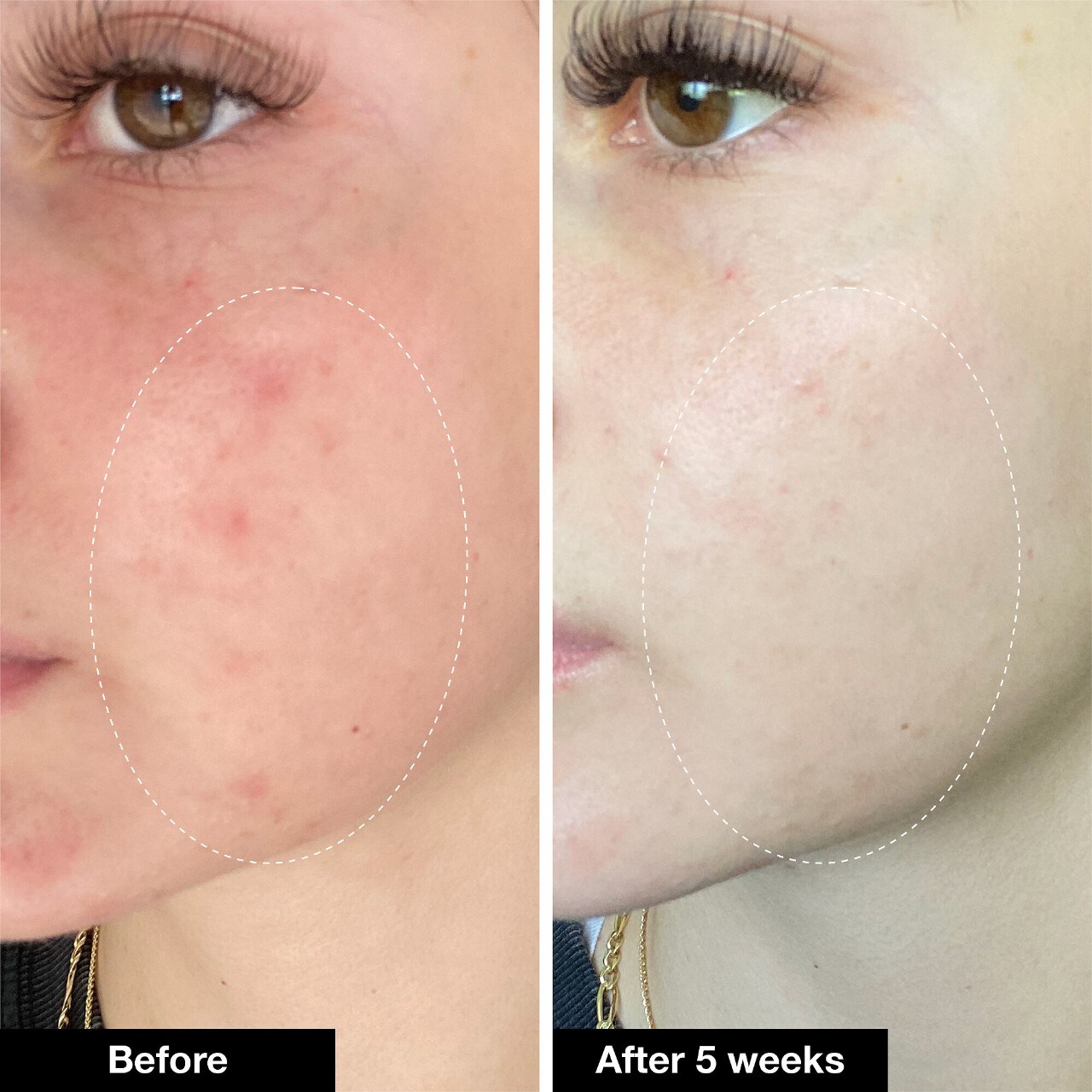 INNBEAUTY PROJECT Acne Serum Medicated Treatment for Acne & Blackheads
