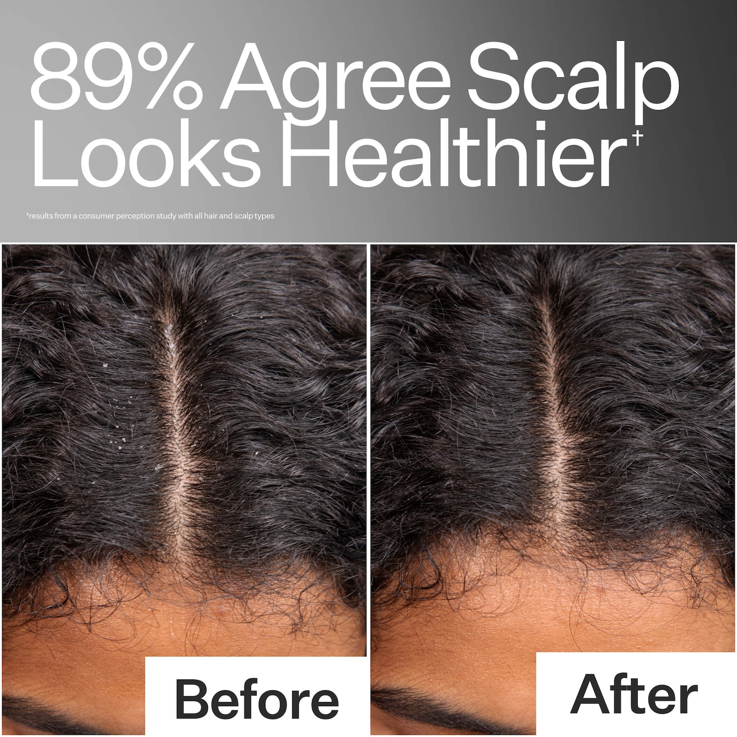 Act+Acre Scalp Relief System - Thumbnail 5