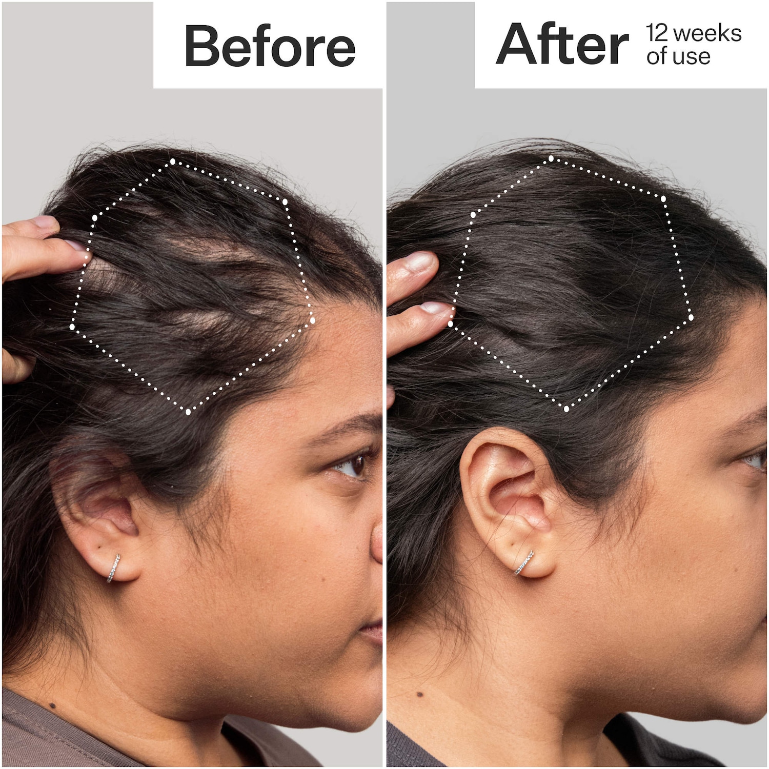 3% Stem Cell Peptide Hair + Scalp Treatment For Severe Hair