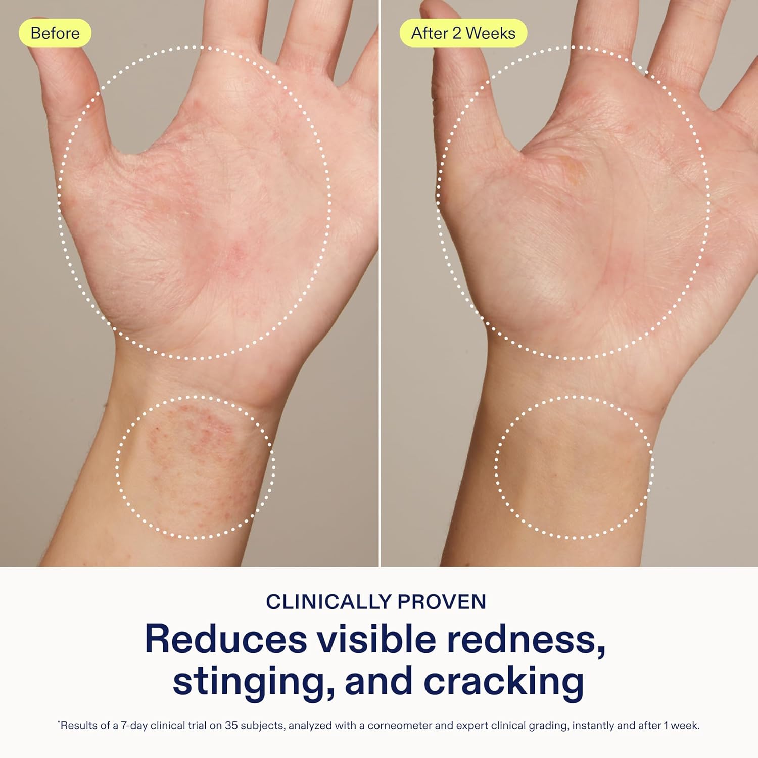 Eczema+ Ceramide Hand + Foot Relief Cream - Skinfix | Sephora
