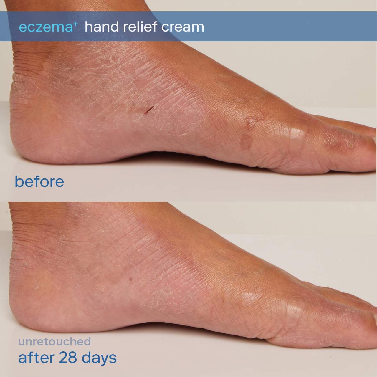 Крем для рук и ног Skinfix Eczema+ с церамидами — фото 3