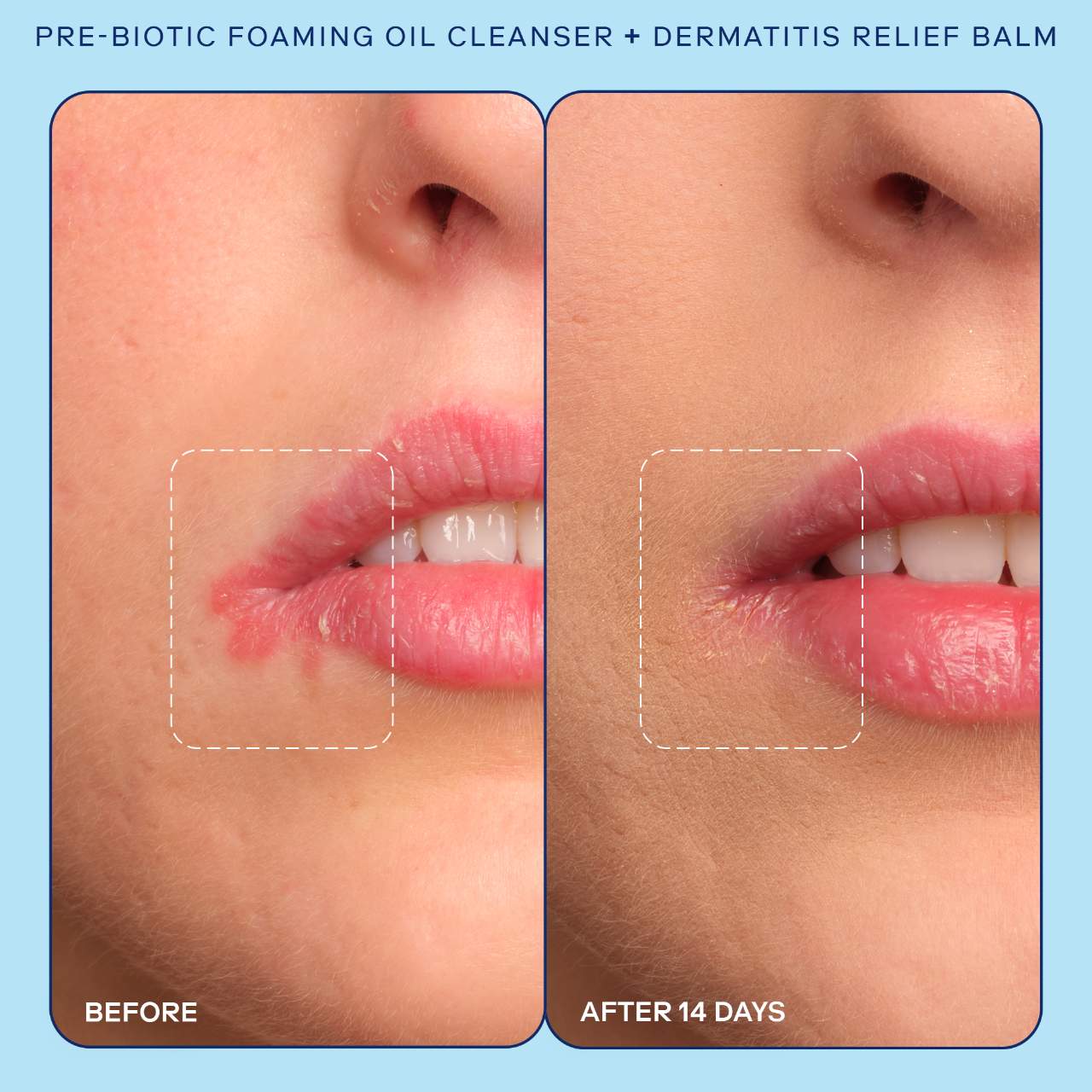 Пенящееся очищающее масло Skinfix Eczema+ с пребиотиками — фото 3
