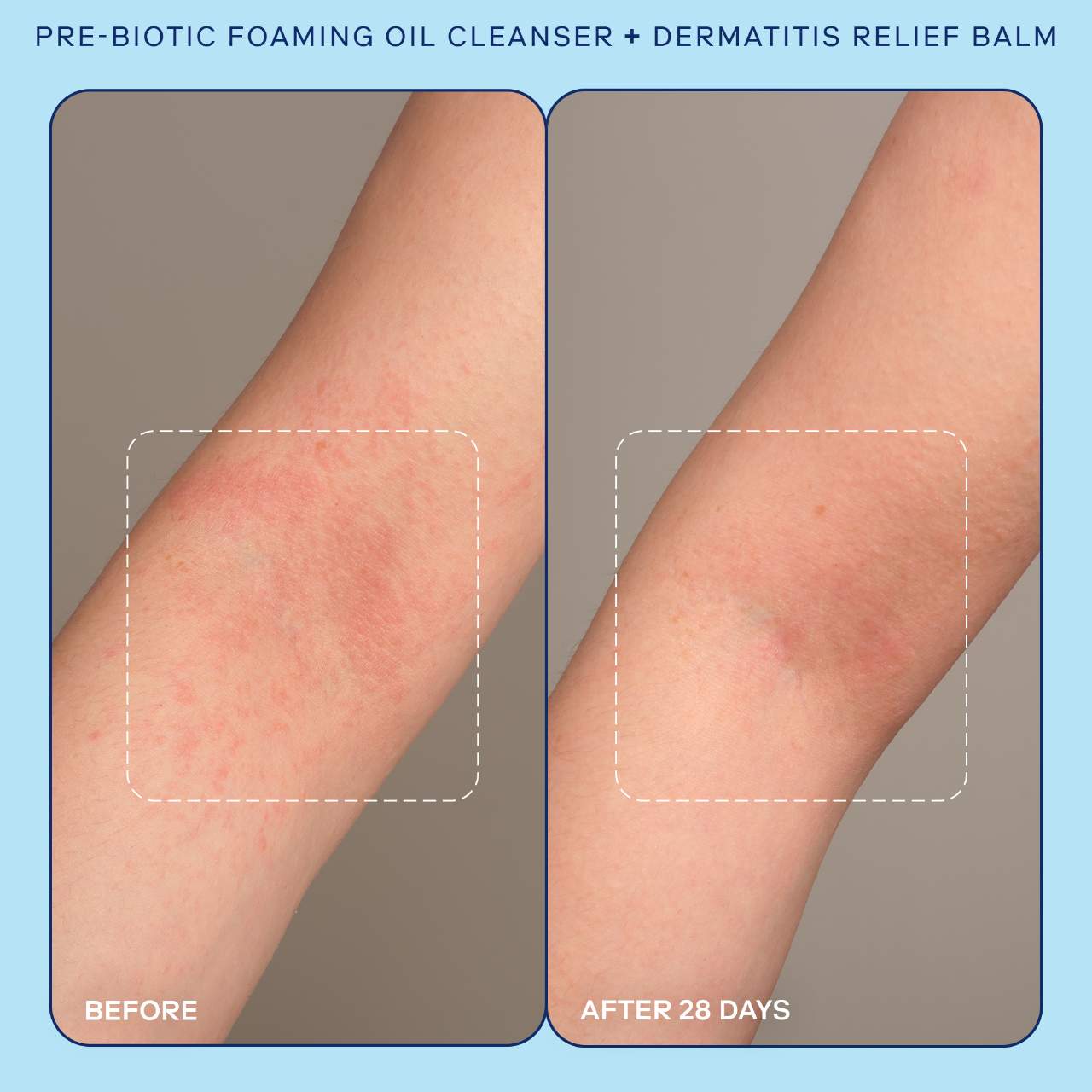 Пенящееся очищающее масло Skinfix Eczema+ с пребиотиками — фото 4