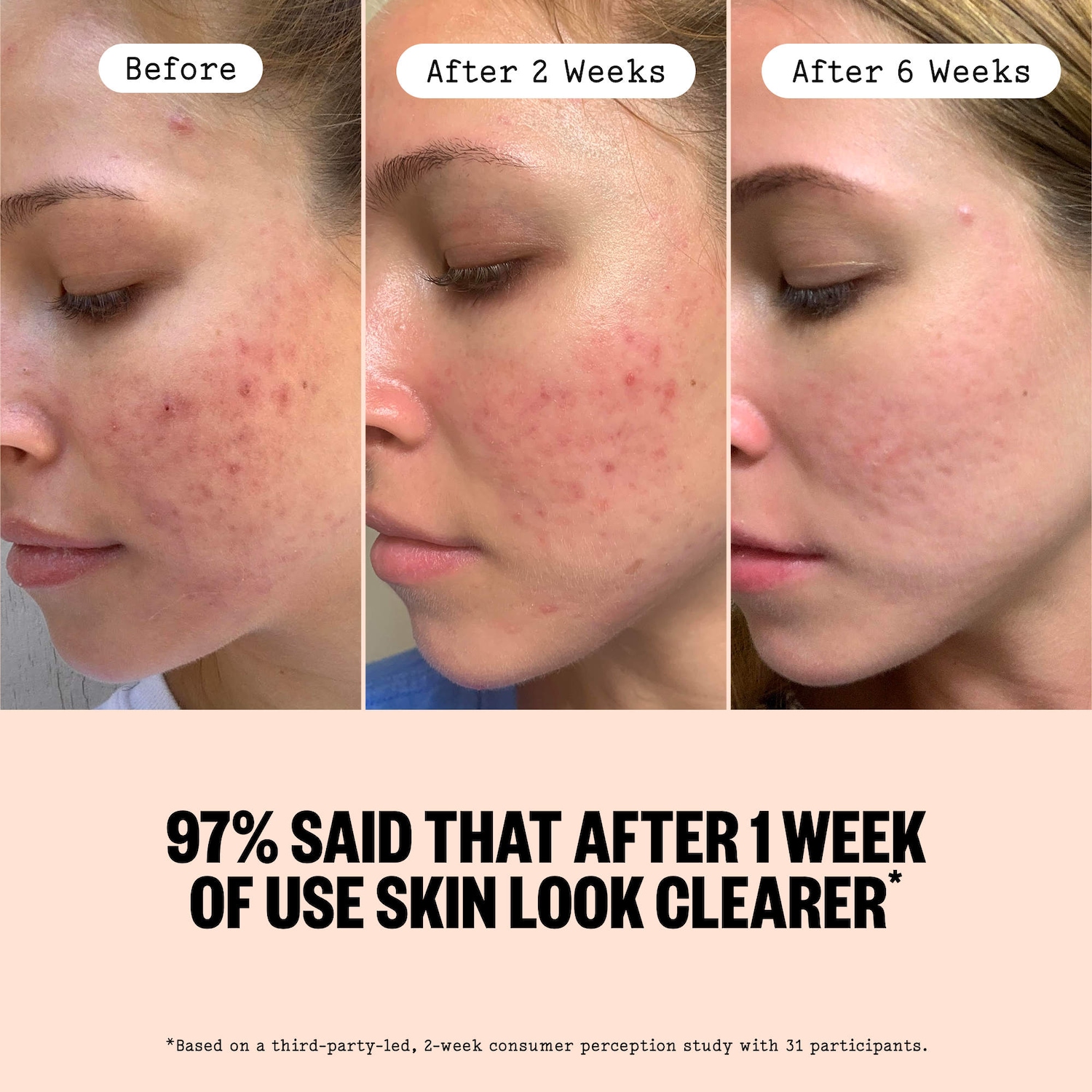 2% Salicylic Acid Daily Acne Treatment Serum