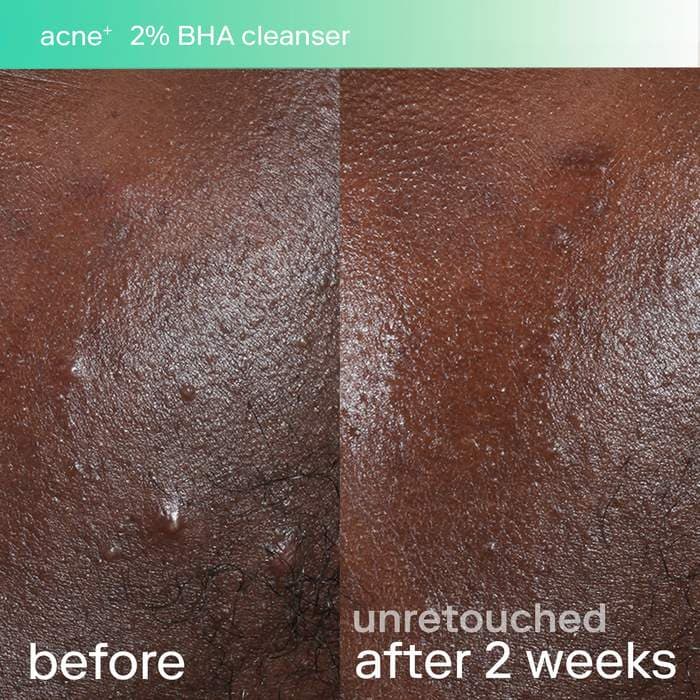 Набор против акне с салициловой кислотой и ниацинамидом Skinfix acne+ triple threat — фото 4