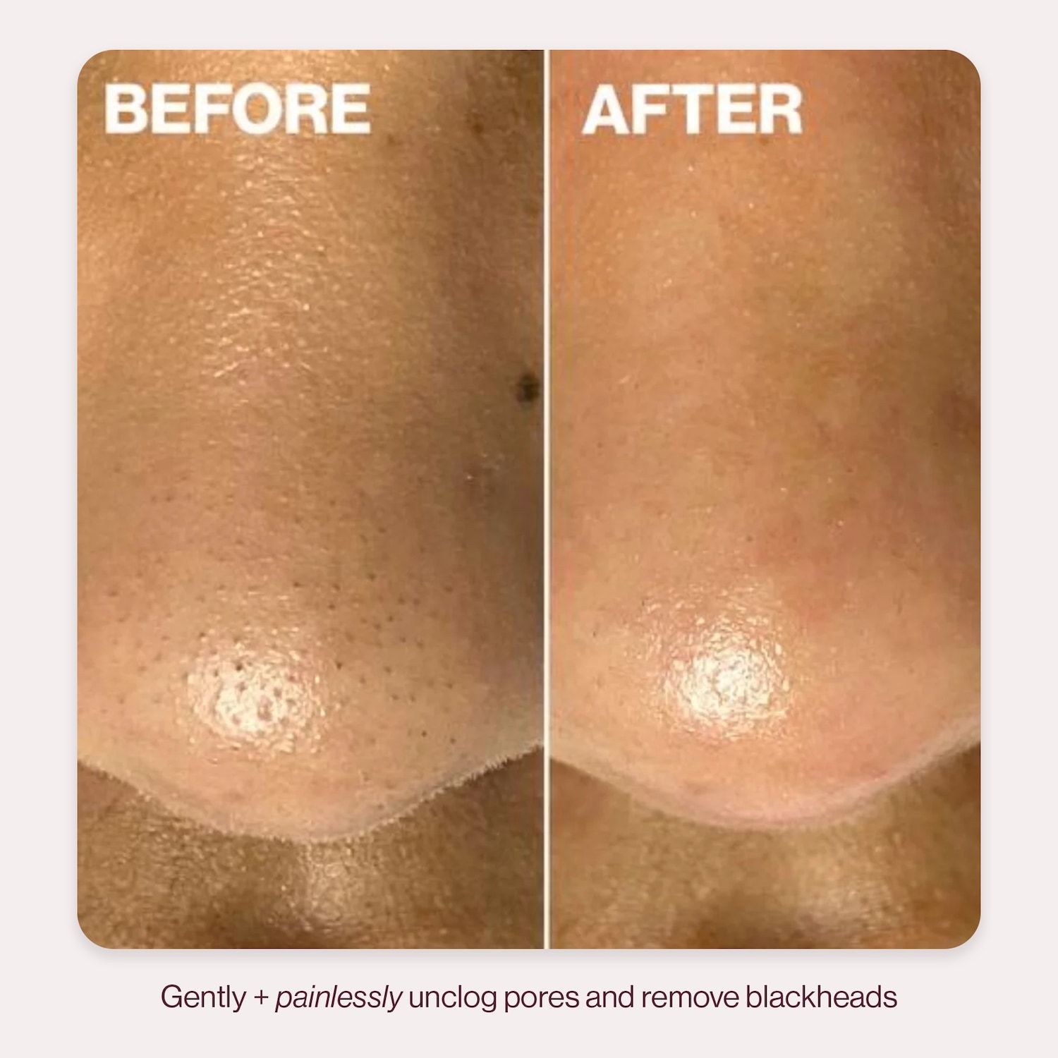 Ультразвуковой очиститель пор и аппарат для ввода средств Dermaflash DERMAPORE+, цвет: Пудровый — фото 5